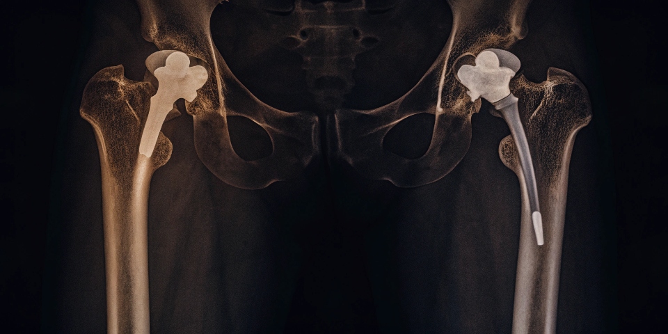titanium is extremely biocompatible meaning it